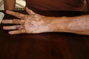 A vitiligo kezelése nem egyszerű